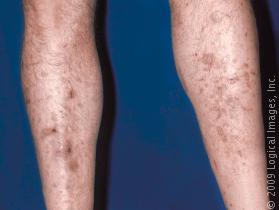 Dark Spots on Legs: Causes, How to Get Rid, Home Remedies 