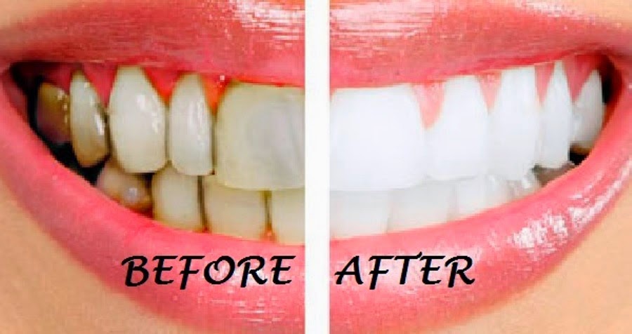 coconut oil pulling brush teeth before or after