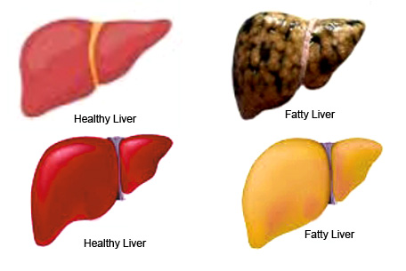 Fatty Liver.