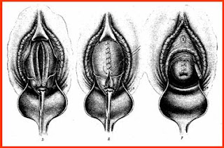 Pelaksanaan Luka Episiotomi (Vulva Hygiene)