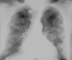 Lung Calcification Meaning, Symptoms, Causes, Treatment