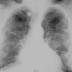 Lung Calcification Meaning, Symptoms, Causes, Treatment