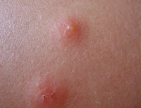 ABOVE: Bedbug Bites