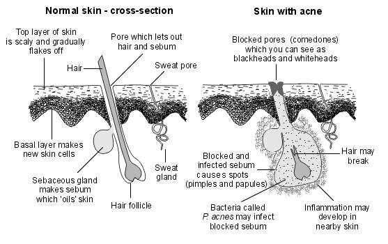 Normal skin vs acne skin