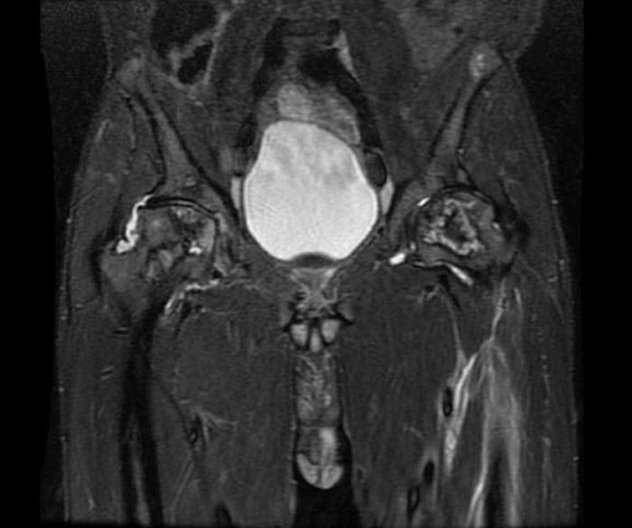 Doctors Gates: Avascular necrosis: etiology in one word