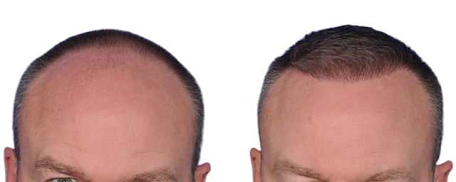 Uomo di 55 anni, prima e dopo il trapianto di capelli con metodo FUE Zaffiro a Tirana, Albania