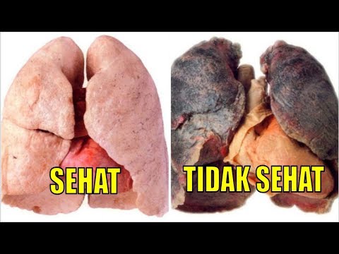 Jenis Obat Herbal Paru-paru basah, 100% alami dan berkhasiat 