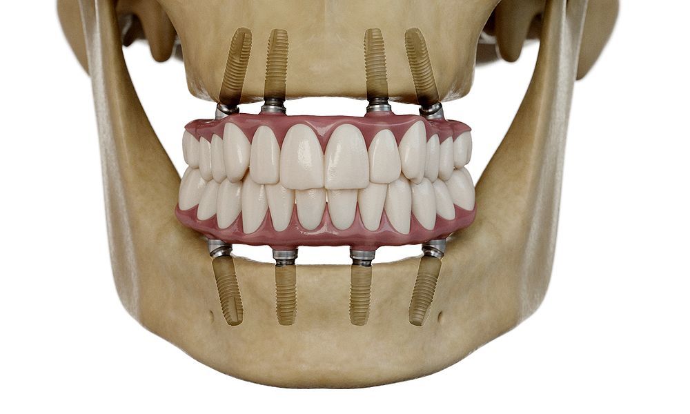 Implantes Dentales