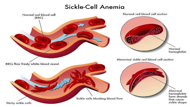 Risk Factorsm for Sickle Cell Anemia