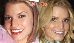 Jessica Simpson Plastic Surgery Before And After
