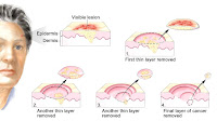 Blue Light Skin Cancer Treatment Side Effects