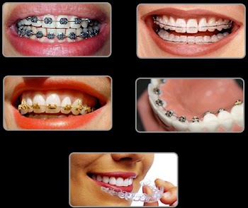 Niềng răng thẩm mỹ