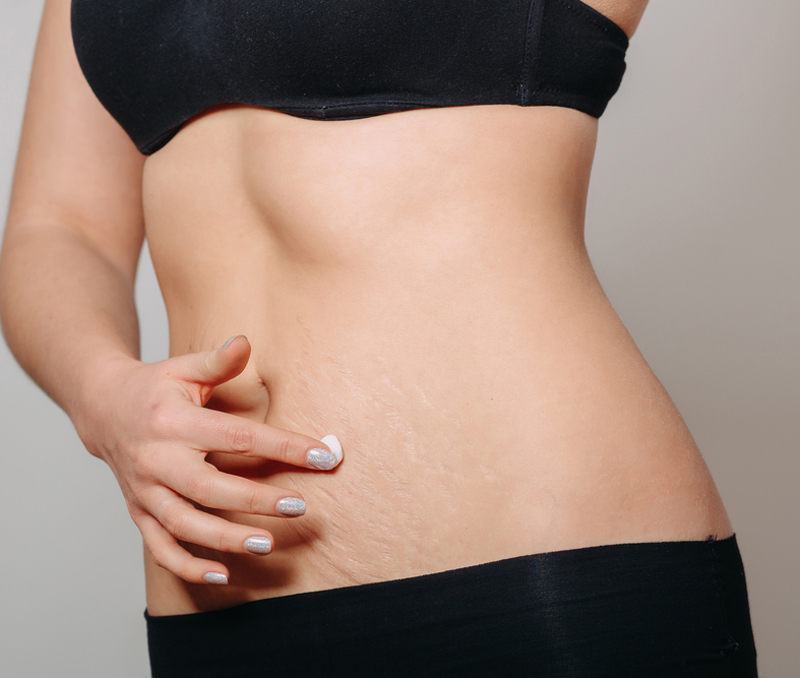 Natural Remedies for Stretch Marks