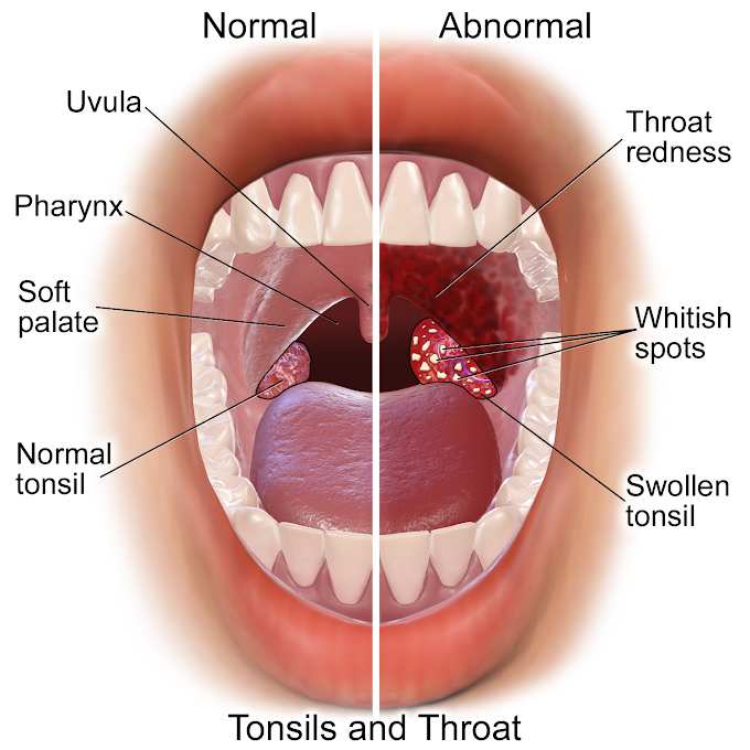 Best Ayurvedic Treatment for Tonsils - Ayurvedic Remedies and medicine and for Tonsillitis