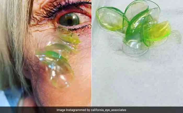 Video Shows Doctor Removing 23 Contact Lenses From Patient's Eye Who 'Forgot' To Take Them Off, News, Doctor, Social Media, Video, Doctor, Woman, World