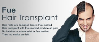 hair transplant treatments