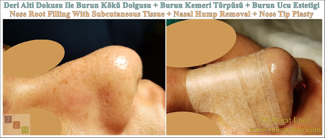 Deri altı dokusu ile burun kökü dolgusu - Burun ucu estetiği - Burun kemeri törpüsü - Kemik kırılmadan burun estetiği - Erkek burun estetiği - Burun kanadı çökmesi tedavisi - Burun ucu kaldırma - Burun ucu daraltma - Lokal anestezi altında burun estetiği - Burun kemeri törpüleme - Bayan burun estetiği