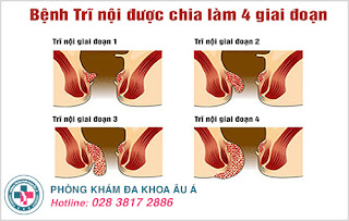 Các Giai Đoạn Của Bệnh Trĩ Nội