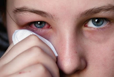 Summer Eye infection tips 