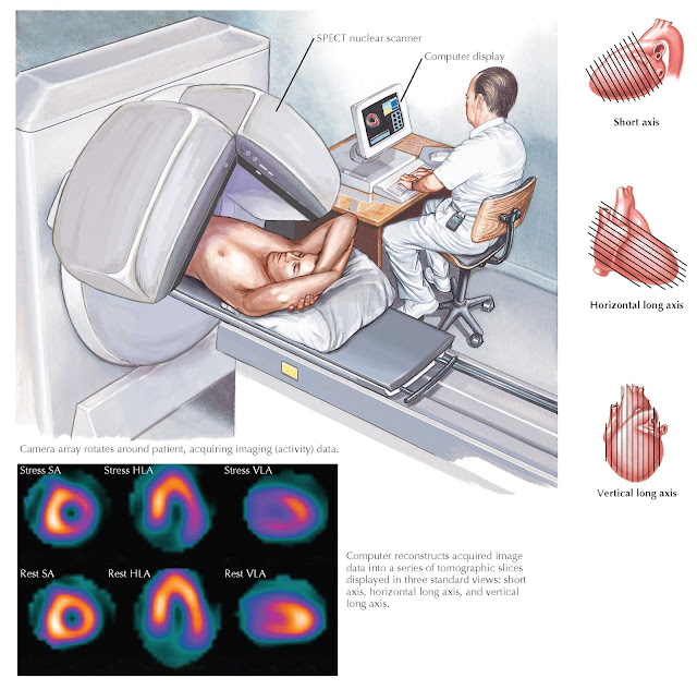 Stress Nuclear Imaging by SPECT. Lateral wall shows normal perfusion at rest, but decreased   at stress consistent with ischemia.