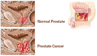 Sekresi Hormon Dan Kanker Prostat