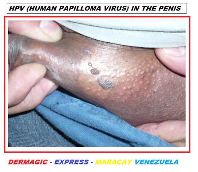 VPH, lesiones verrugosas en pene