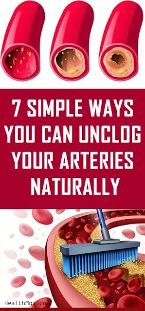 7 Simple Ways You Can Unclog Your Arteries Naturally