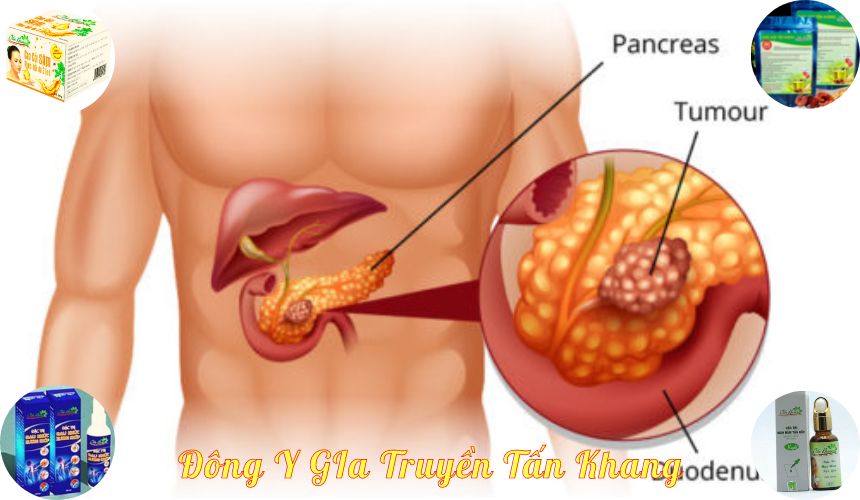 Bệnh ung thư tụy, triệu chứng và chẩn đoán