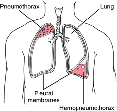 Hemopneumothorax Definition, Symptms, Causes, Treatment