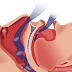 Sleep Apnea Syndrome Treatment