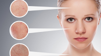 Acne Rosacea Treatment