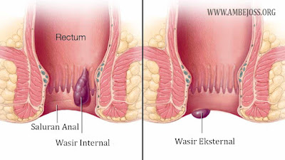 Wasir Dalam dan Wasir Luar