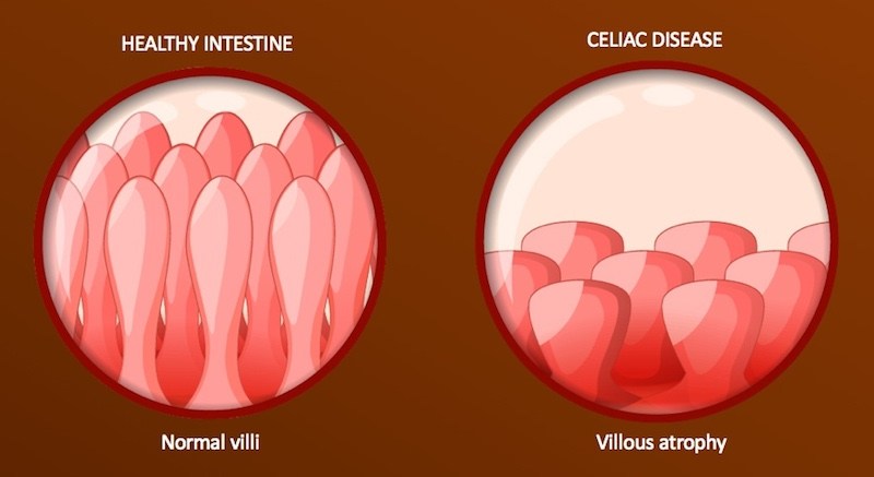 Celiac Diseases at A Glance 