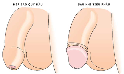 Hep-bao-quy-dau-truoc-va-sau-tieu-phau