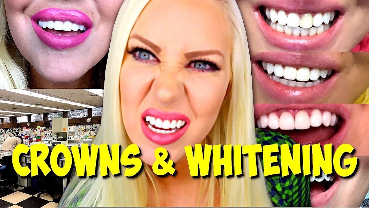 How Often Can You Get Your Teeth Whitened