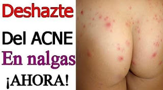 como quitar el acne en los gluteos