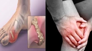 Here's how to prevent gout | recognize the symptoms