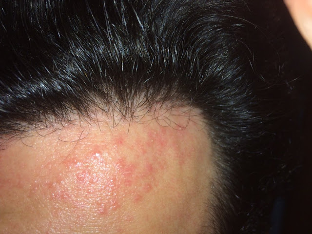 Alergia al minoxidil