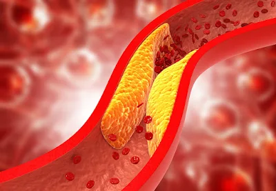 A heart illustration with cholesterol buildup in arteries, highlighting the connection to kidney health.