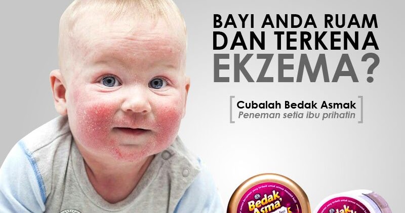 Ekzema pada bayi? -  ANAK KEDAH