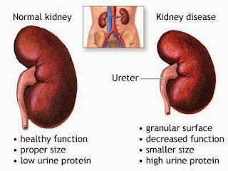 Penyebab Penyakit Ginjal 