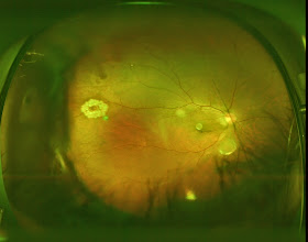All things eye Por Yong Ming: Floaters, flashes of light and retina 