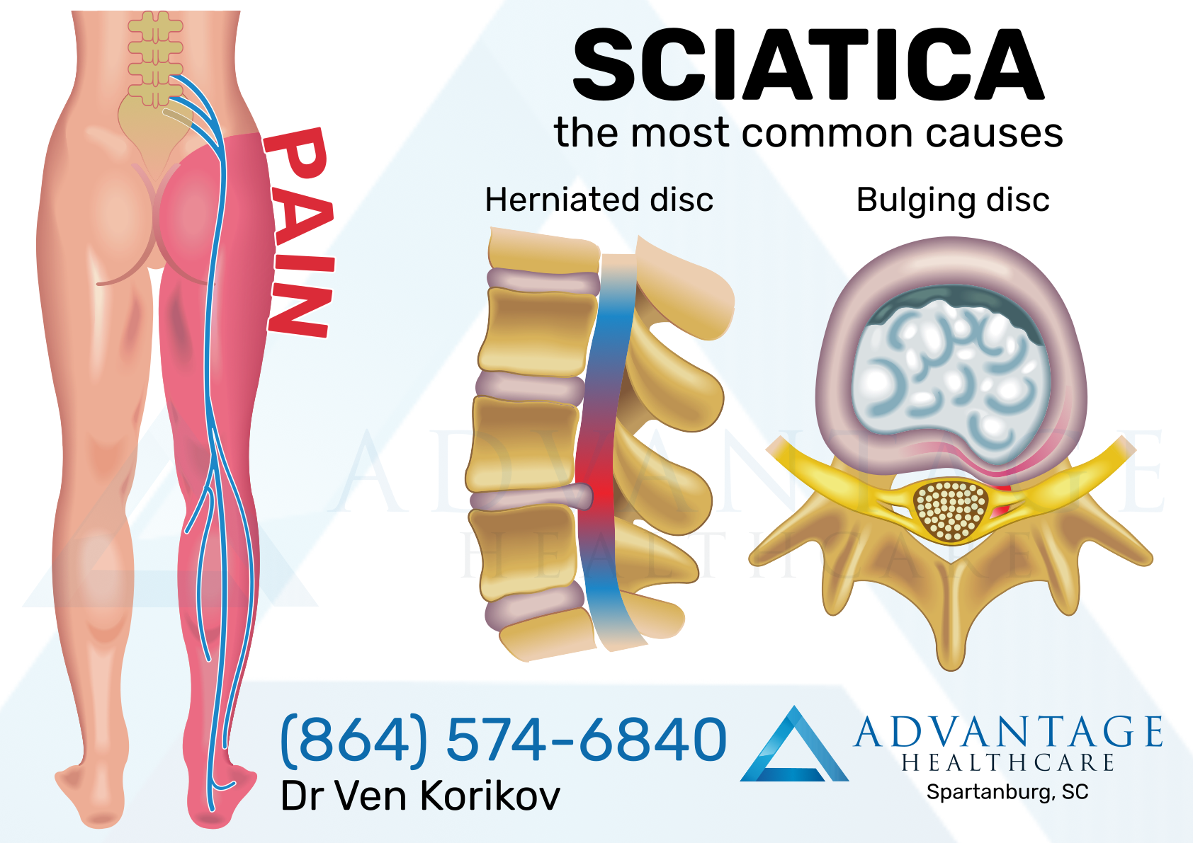 Bulging & Herniated Discs, Chiropractor in Sioux City, IA