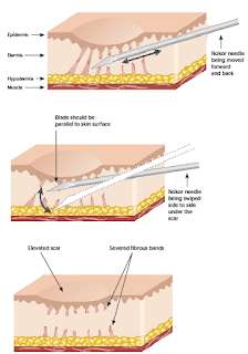 subcision-acne-scar-treatment