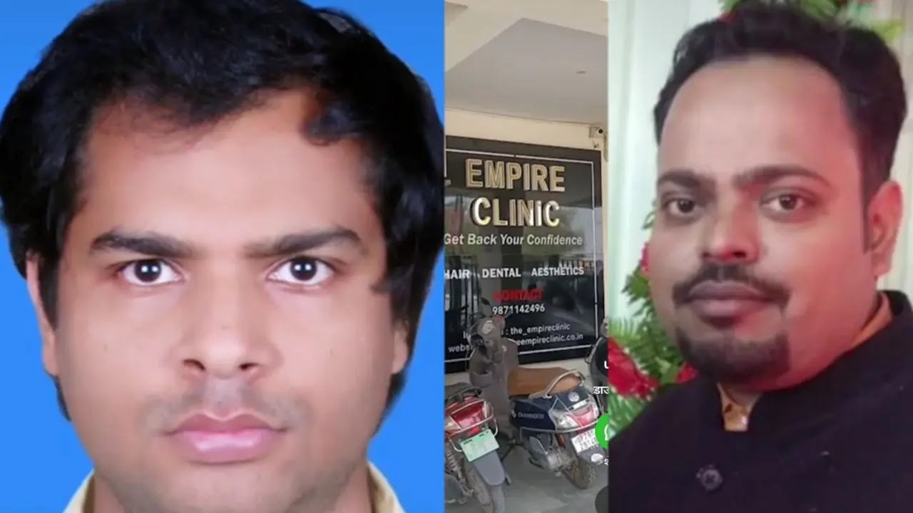 कानपुर के अंपायर क्लीनिक में हेयर ट्रांसप्लांट के बाद दो इंजीनियर की मौत एक की मां ने बताया चेहरा सूजने लगा, रात भर दर्द से रोता रहा मेरी गोद में तोड़ा दम