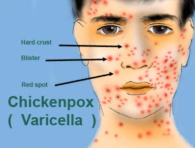 Bintik Yang Terasa Gatal Di Lengan Dan Kaki Karena Impetigo (Infeksi Bakteri)