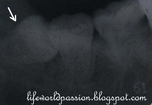 My life. my world. my passion.: Pengalaman sakit gigi 