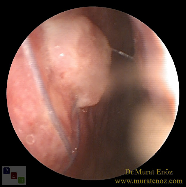 Ekstrakorporeal septum perforasyonu tamiri - Ekstrakorporeal septum perforasyonu ameliyatı - Septum perforasyonu tedavisi - Nazal septum perforasyonu operasyonu - Açık teknik ekstrakorporeal septum perforasyonu ameliyatı - Açık teknik ekstrakorporeal septum perforasyonu onarımı - Burun estetiği ile birlikte ekstrakorporeal septum perforasyonu kapatılması - Ekstrakorporeal burun septumunda delik kapatılması - Burunda delik oluşumu - Burun duvarında delik - Burun kıkırdak delinmesi tedavisi - Septum perforasyonu ameliyatı olanlar - Septum perforasyonu olanlar - Septal perforasyon tamiri - Ekstrakorporeal burun septum perforasyonu ameliyatı - Extracorporeal septum perforation closure in Istanbul - Extracorporeal septum perforation closure in Turkey - Extracorporeal closure of nasal septal perforations subcutaneous tissue - Combining rhinoplasty with extracorporeal septal perforation repair