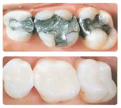 Dental fillings