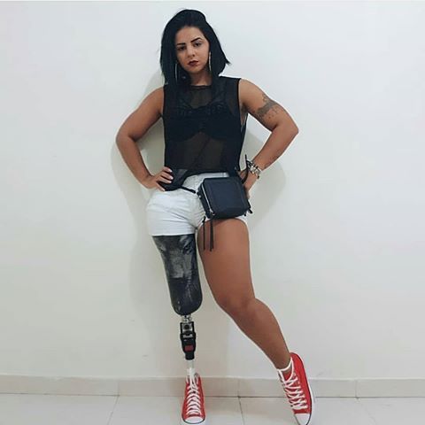 Amputee girls gets prosthesis